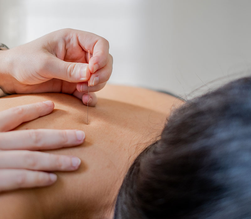 Dry Needling
